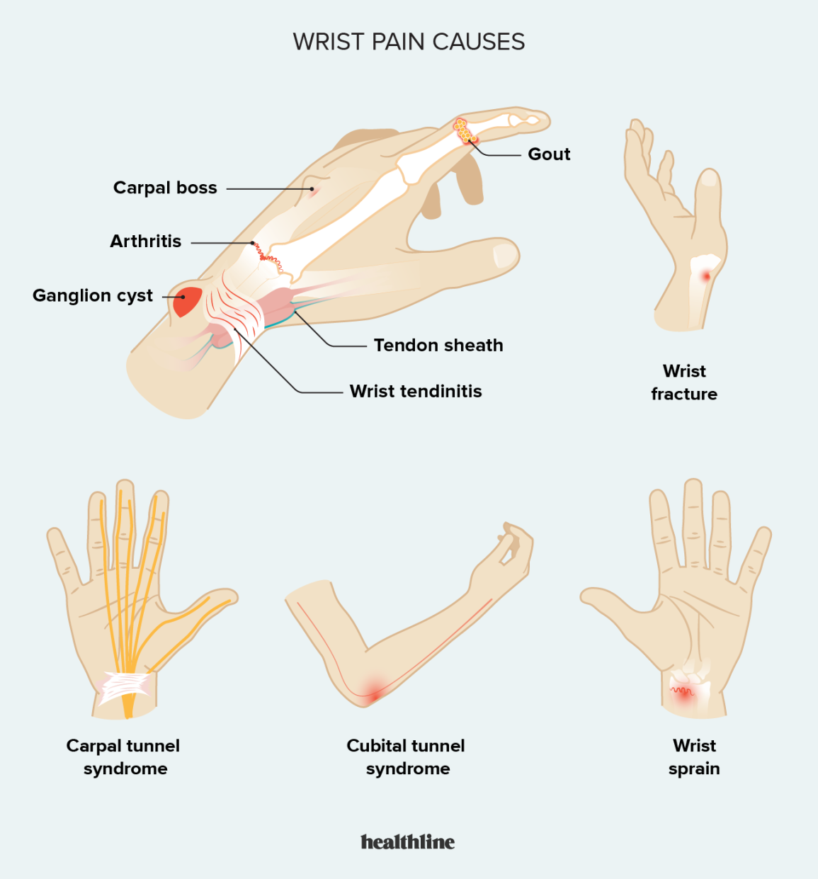 1867865-Possible-Causes-of-Wrist-Pain-and-Treatment-Tips-1296x728-body.webp