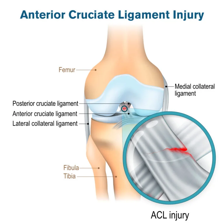 ACL-Injury-Treatment-lahore.webp