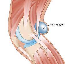 Bakers-Cyst.jpg