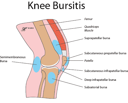 Knee-bursitis.gif