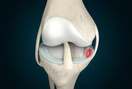 Meniscus-Tear.jpg