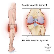 Posterior-Cruciate-Ligament-PCL-Injury.jpg