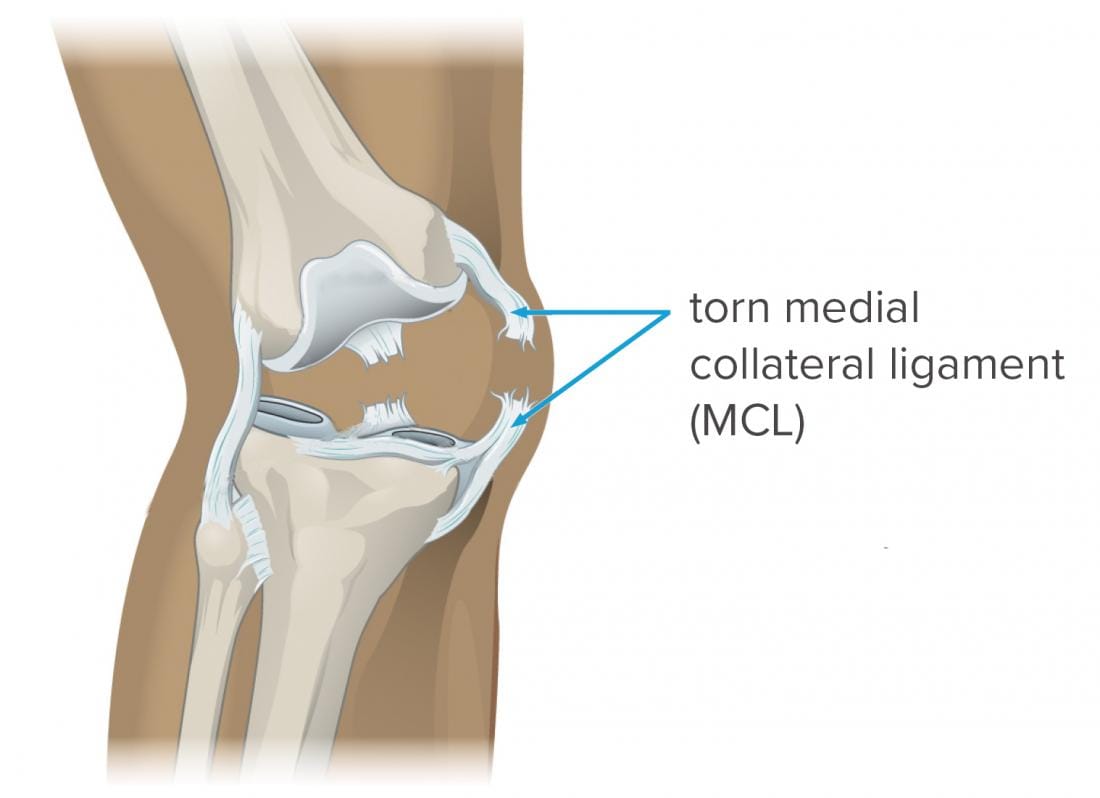 medial-collateral-ligament-mcl-tear-picture.jpg