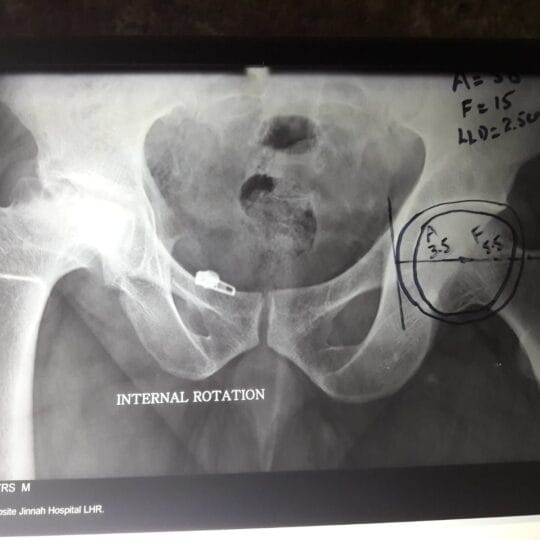 Knee X-Ray Analysis & Diagnosis | Orthopedic Specialist