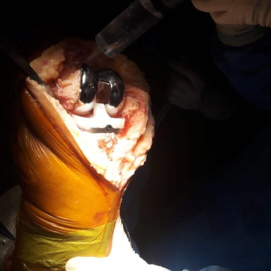 Bone and joint surgical treatment by orthopedic specialist