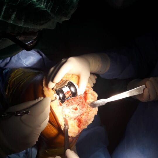 Orthopedic surgical treatment for severe knee injury
