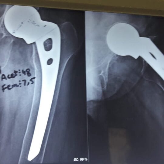 Dr. Tahseen Riaz conducting precision joint surgery