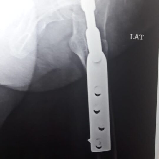 Orthopedic operation for knee ligament reconstruction
