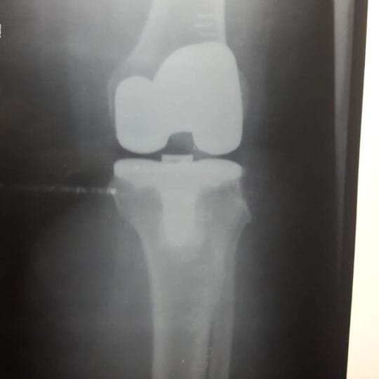 Expert orthopedic surgeon performing joint repair surgery