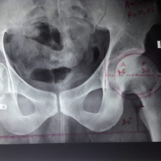 Orthopedic surgical treatment for damaged knee cartilage