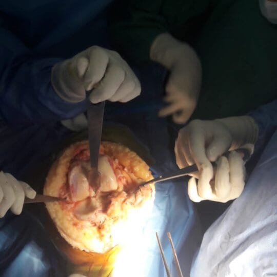 Bone and joint surgery performed by Dr. Tahseen Riaz