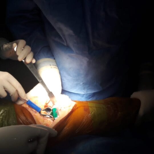 Prof. Dr. Tahseen Riaz performing knee replacement surgery in operating room