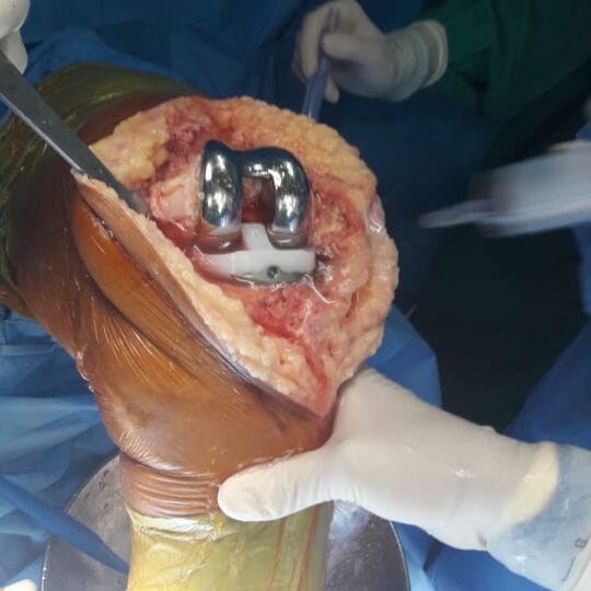 Orthopedic surgeon Dr. Tahseen Riaz conducting advanced knee surgery