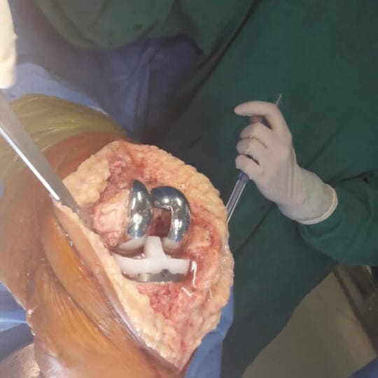 Knee joint surgery procedure by orthopedic surgeon in Lahore