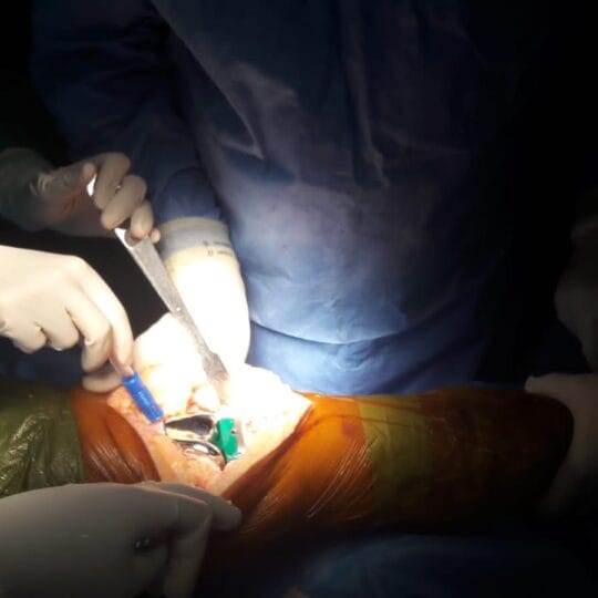 Dr. Tahseen Riaz performing total knee replacement operation