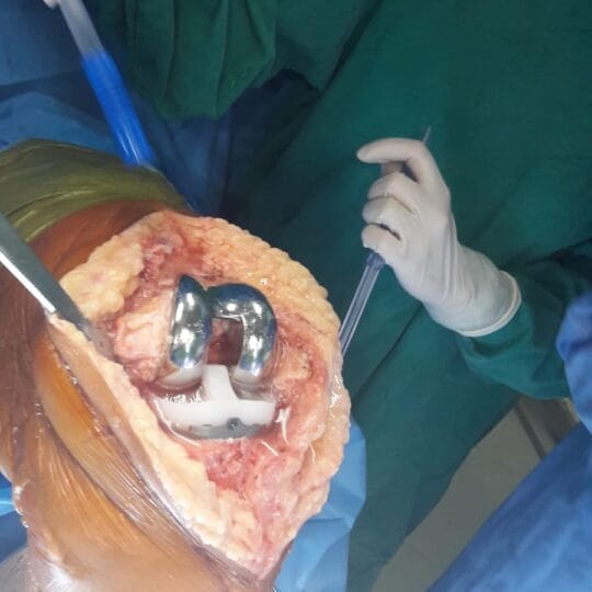 Orthopedic surgical procedure for knee joint repair