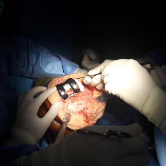 Dr. Tahseen Riaz conducting orthopedic surgery in hospital operating theater