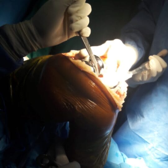 Advanced orthopedic knee surgery by Prof. Dr. Tahseen Riaz