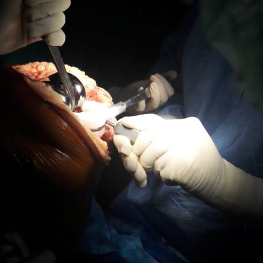 Orthopedic surgeon performing joint replacement procedure