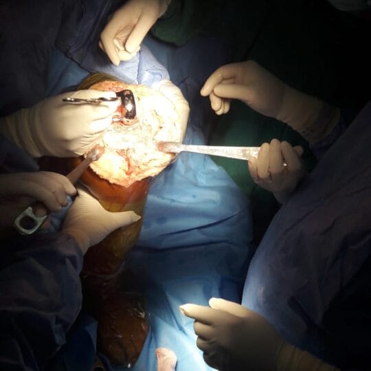 Surgical team assisting Dr. Tahseen Riaz during knee operation