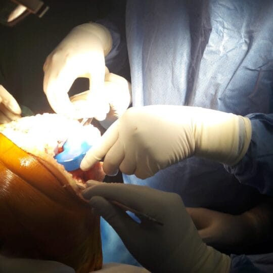 Orthopedic knee surgery procedure for joint reconstruction